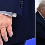 Health Concerns Emerge as Large Bruise Is Seen on President Trump’s Hand During Davos Speech