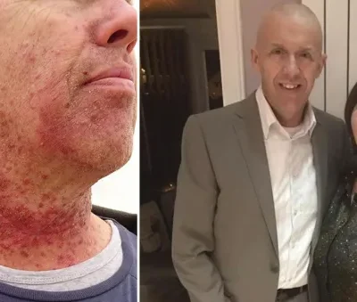 Man had dormant STI from oral s3x for 30 years before it became life-threatening