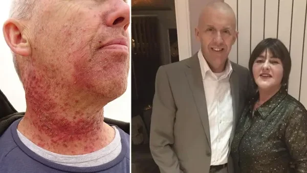 Man had dormant STI from oral s3x for 30 years before it became life-threatening