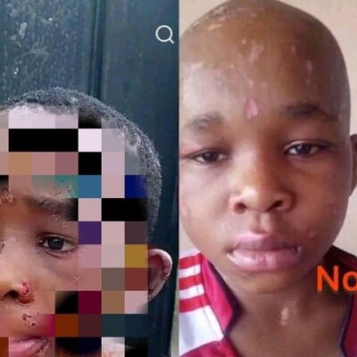 New photo of 10-year-old boy severely b@ttered by his guardian in Anambra
