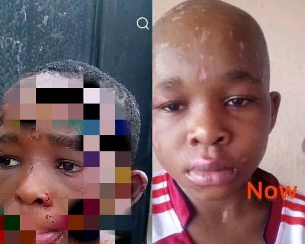 New photo of 10-year-old boy severely b@ttered by his guardian in Anambra